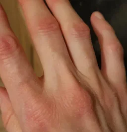 swelling