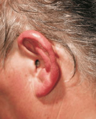 swollen ear
