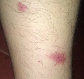 itchy legs
