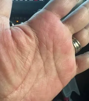 itchy hand gluco extend