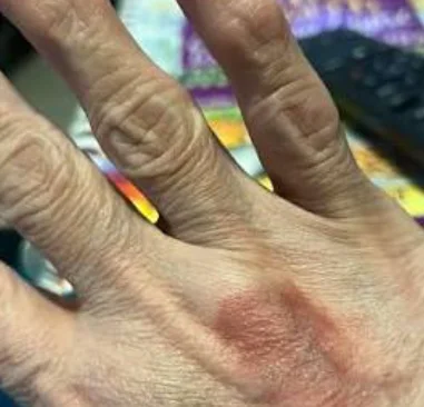 hands swelling
