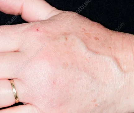 swelling hands